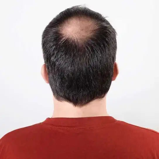 La parte trasera de la cabeza de un hombre con entradas.