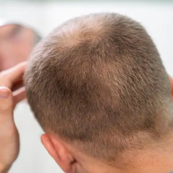 El cuero cabelludo de un hombre con visible adelgazamiento del cabello en la coronilla.