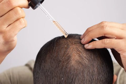 5 Errores que empeoran la alopecia en hombres ¡evítalos!