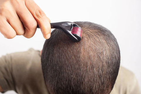 Alopecia androgénica ¿qué es y cómo erradicarla?