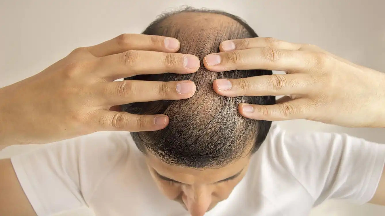 Una persona examinando su línea de cabello en retroceso y su cabello delgado.