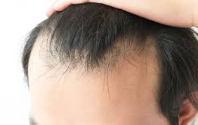 Alopecia: Tipos, Causas, Síntomas y Tratamientos